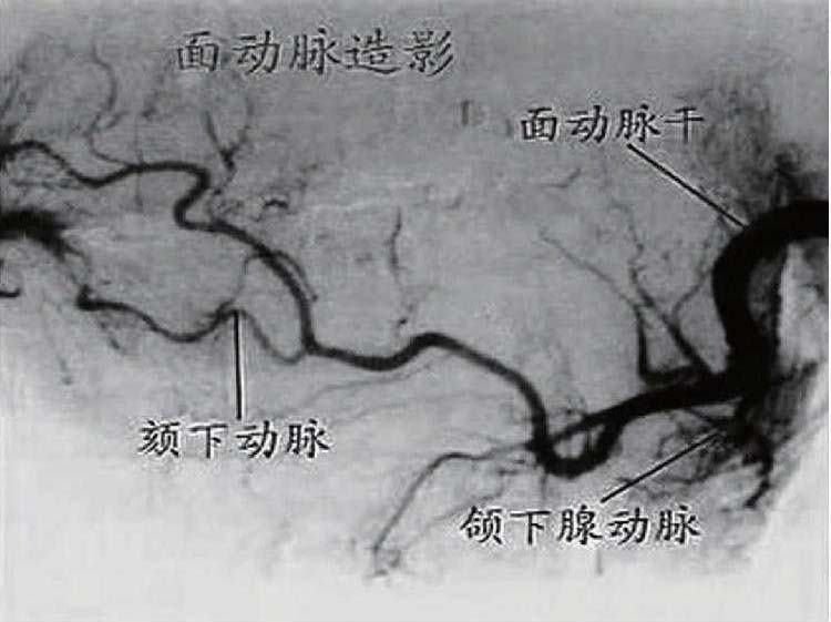 三、頸外動(dòng)脈